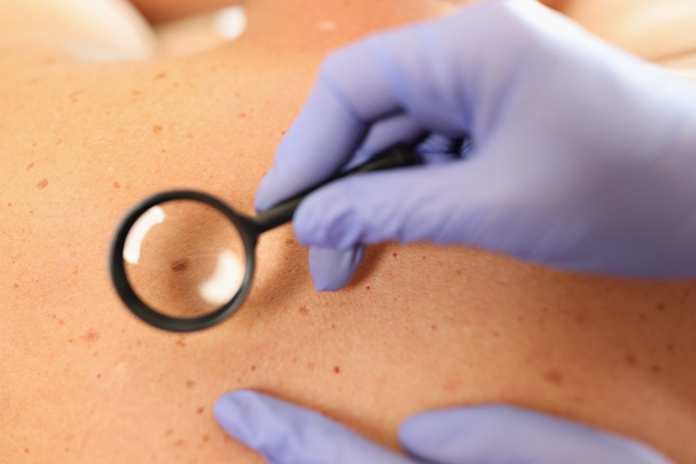 A doctor examining moles on a patient's back with a magnifier