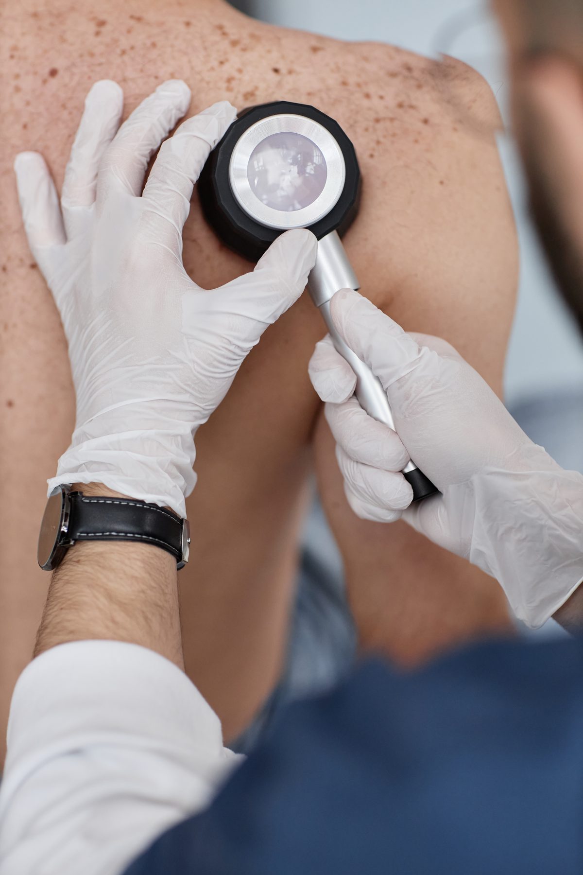 A doctor examining a patient's back with a dermatoscope